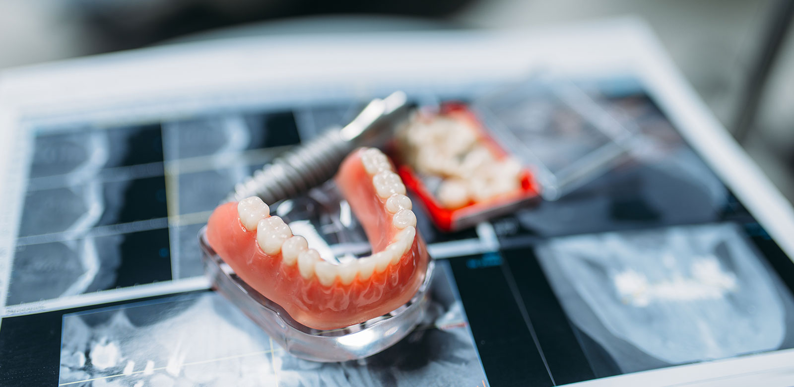 Implant-supported overdenture for improved stability